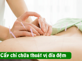 Cấy Chỉ Điều Trị Thoát Vị Đĩa Đệm Đốt Sống Lưng
