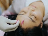 Châm Cứu Điều Trị Liệt Mặt ( Thân Kinh Số 7 )